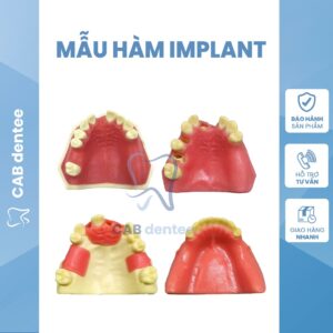 MẪU HÀM THỰC HÀNH CẮM IMPLANT